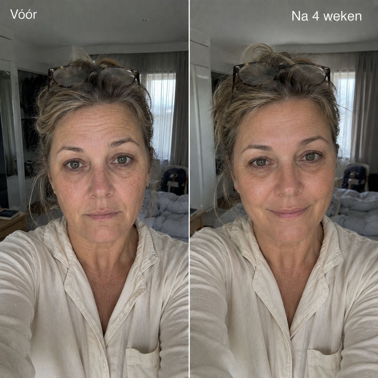 Anti-Rimpel Infusie Behandeling™