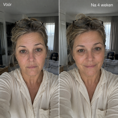 Anti-Rimpel Infusie Behandeling™