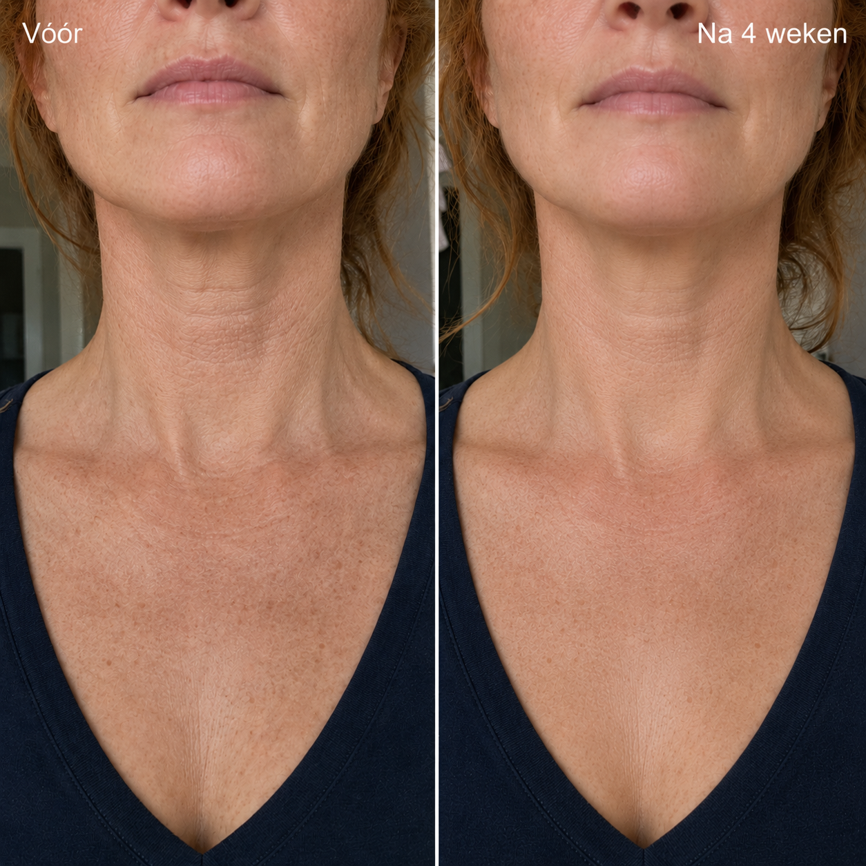Anti-Rimpel Infusie Behandeling™